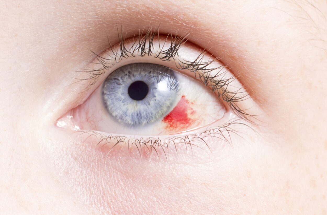 Broken Blood Vessel In Eye