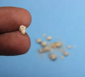 Kidney Stones