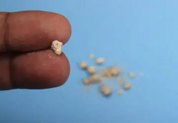 Kidney Stones