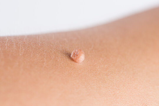 Skin Tags