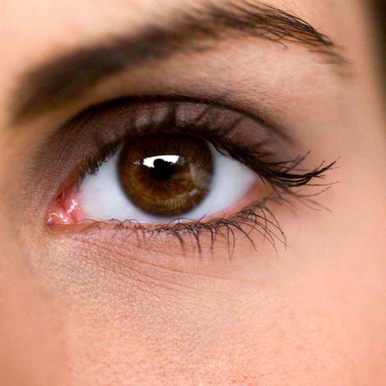 Limbal Rings