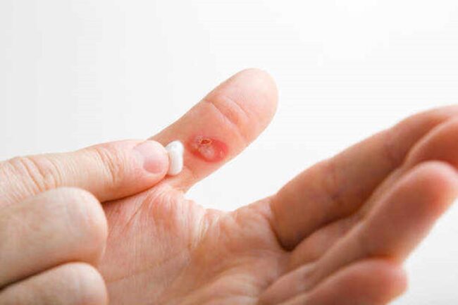 Spiritual Meaning of Burning Your Finger